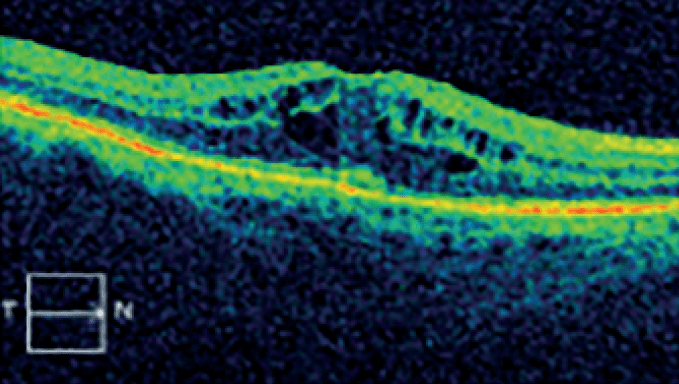 Swollen Macula